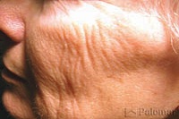 Skin Resurfacing for Wrinkles