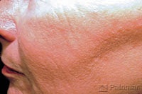 Skin Resurfacing for Wrinkles after
