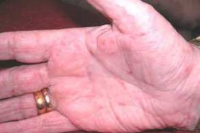 pinnacleskin.com /conditions/scabies Carousel 1 Image 1