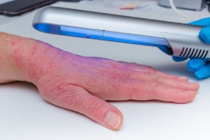 blue-light-therapy-on-hand