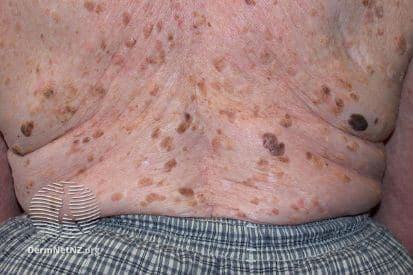 Seborrheic-Keratosis-example