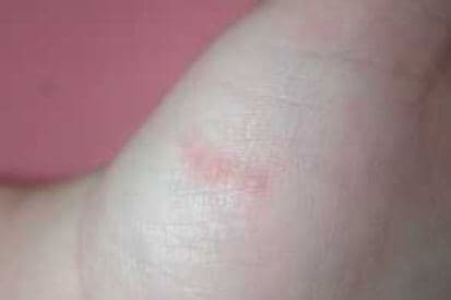 pinnacleskin.com /conditions/scabies Carousel 1 Image 4