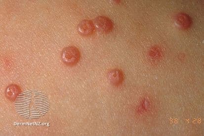 pinnacleskin.com /conditions/molluscum Carousel 1 Image 1