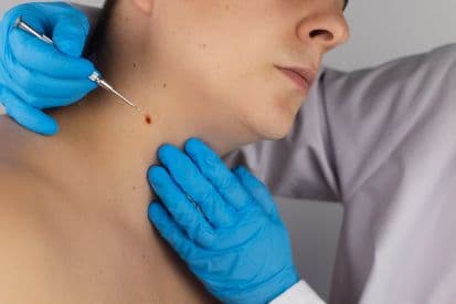 pinnacleskin.com /treatments/standard-excision Carousel 1 Image 1