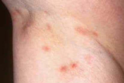 pinnacleskin.com /conditions/scabies Carousel 1 Image 3