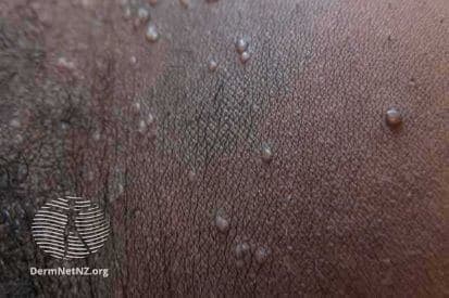 pinnacleskin.com /conditions/molluscum Carousel 1 Image 4